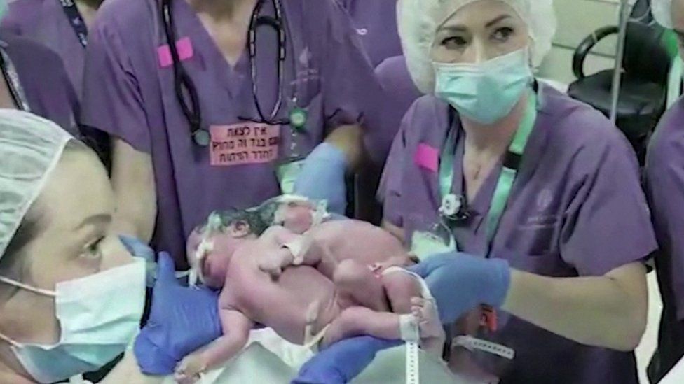 Ізраїлькі  хірурги вперше розділили сіамських близнюків